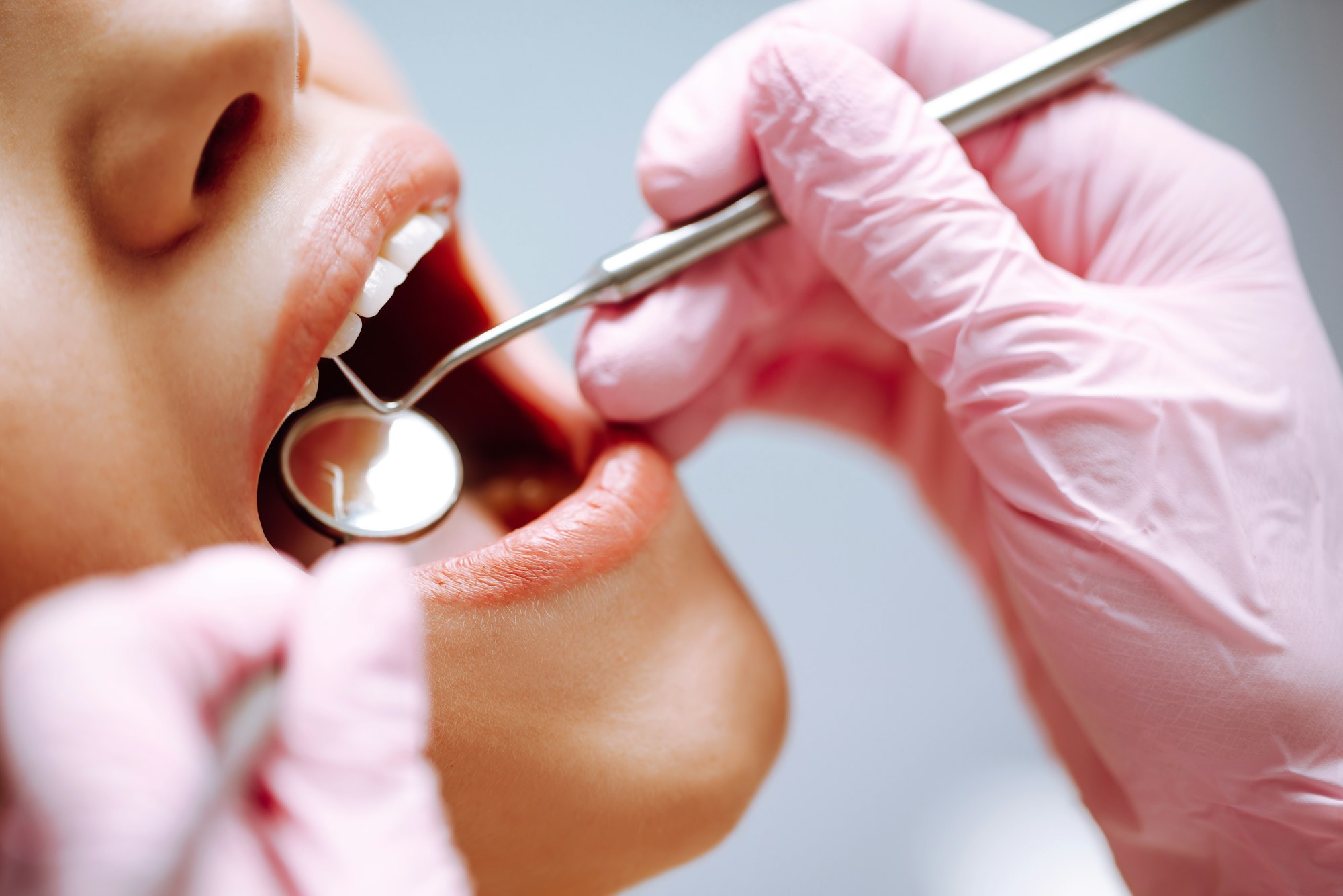 young-woman-at-the-dentist-s-chair-during-a-dental-procedure-overview-of-dental-caries-prevention-.jpg young-woman-at-the-dentist-s-chair-during-a-dental-procedure-overview-of-dental-caries-prevention-.jpg